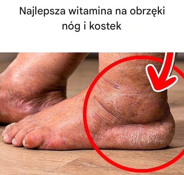 “Naturalne wsparcie na opuchliznę nóg: domowa mieszanka witaminowa”